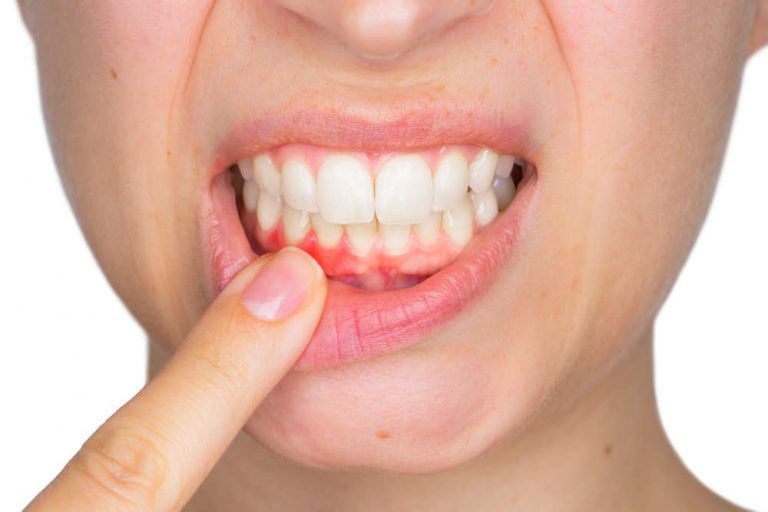 Cómo diagnosticar y tratar la periodontitis