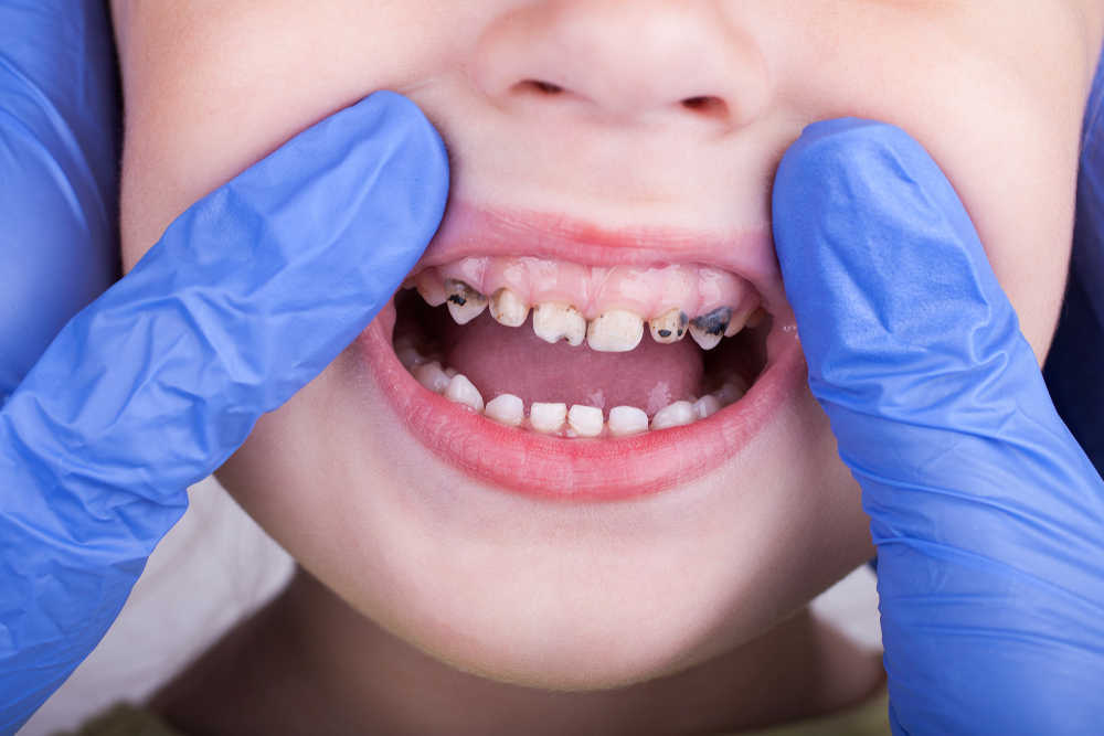 Una mala salud dental sigue siendo habitual entre los menores de nuestro país
