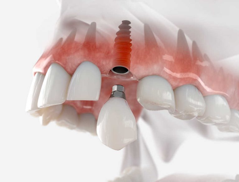 Conoce las ventajas de los implantes dentales
